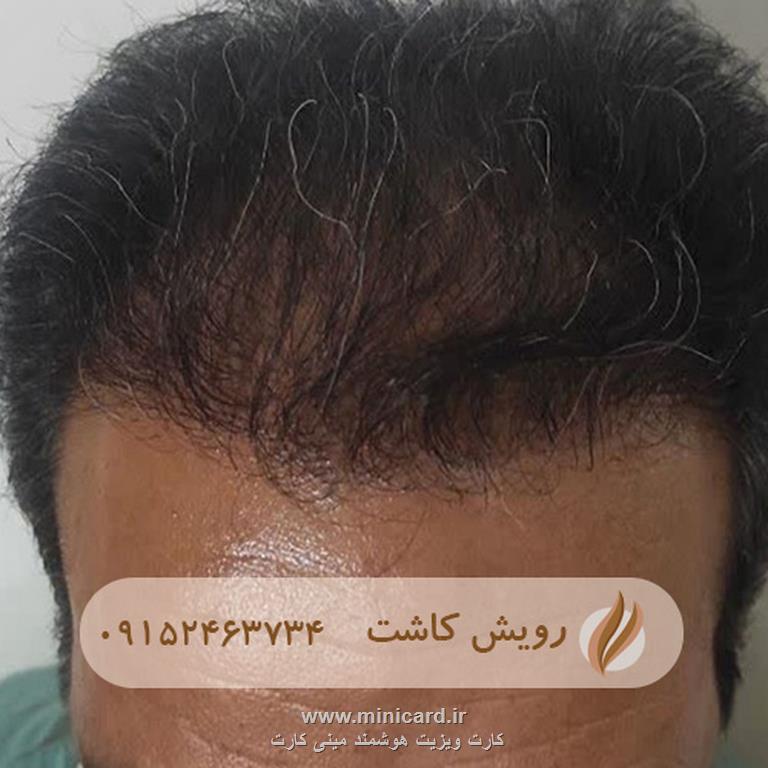 کاشت مو - رویش کاشت