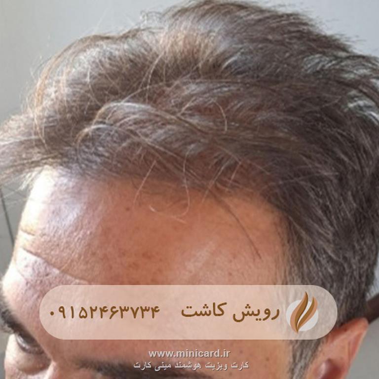 کاشت مو - رویش کاشت