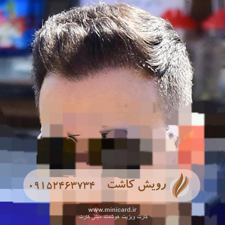 کاشت مو - رویش کاشت