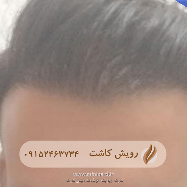 کاشت مو - رویش کاشت