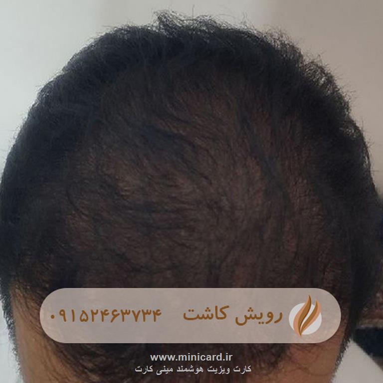 کاشت مو - رویش کاشت